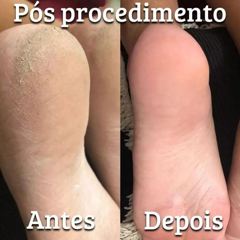 Kit Spa dos Pés Mahav Pro Calo 2x100ml